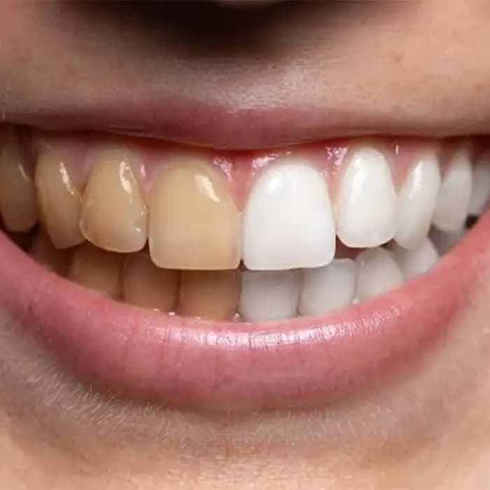 خمیر دندان سفید کننده Whitening فورامن Foramen اسپانیا حجم 125میل — تصویر ۷