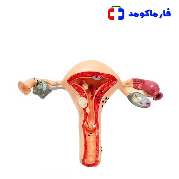 مولاژ بیماری‌های رحم