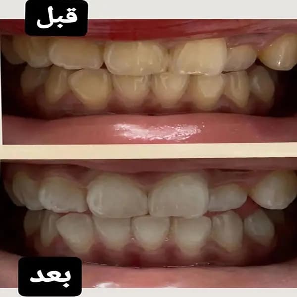 خمیردندان سفیدکننده اسمایل V34 — تصویر ۵