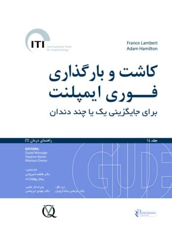 کاشت و بارگذاری فوری ایمپلنت برای جایگزینی یک یا چند دندان جلد 14