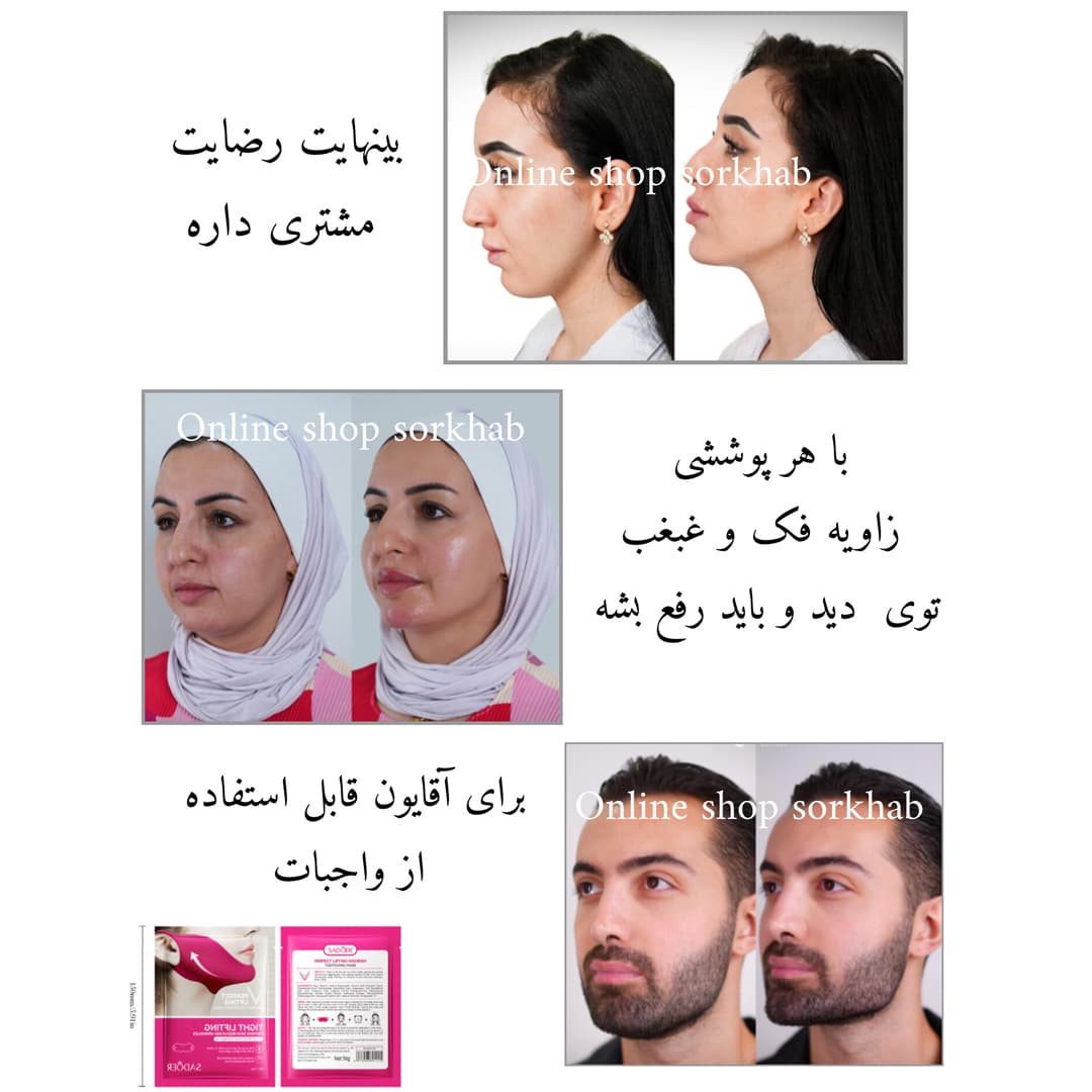 کش رفع غبغب — تصویر ۶