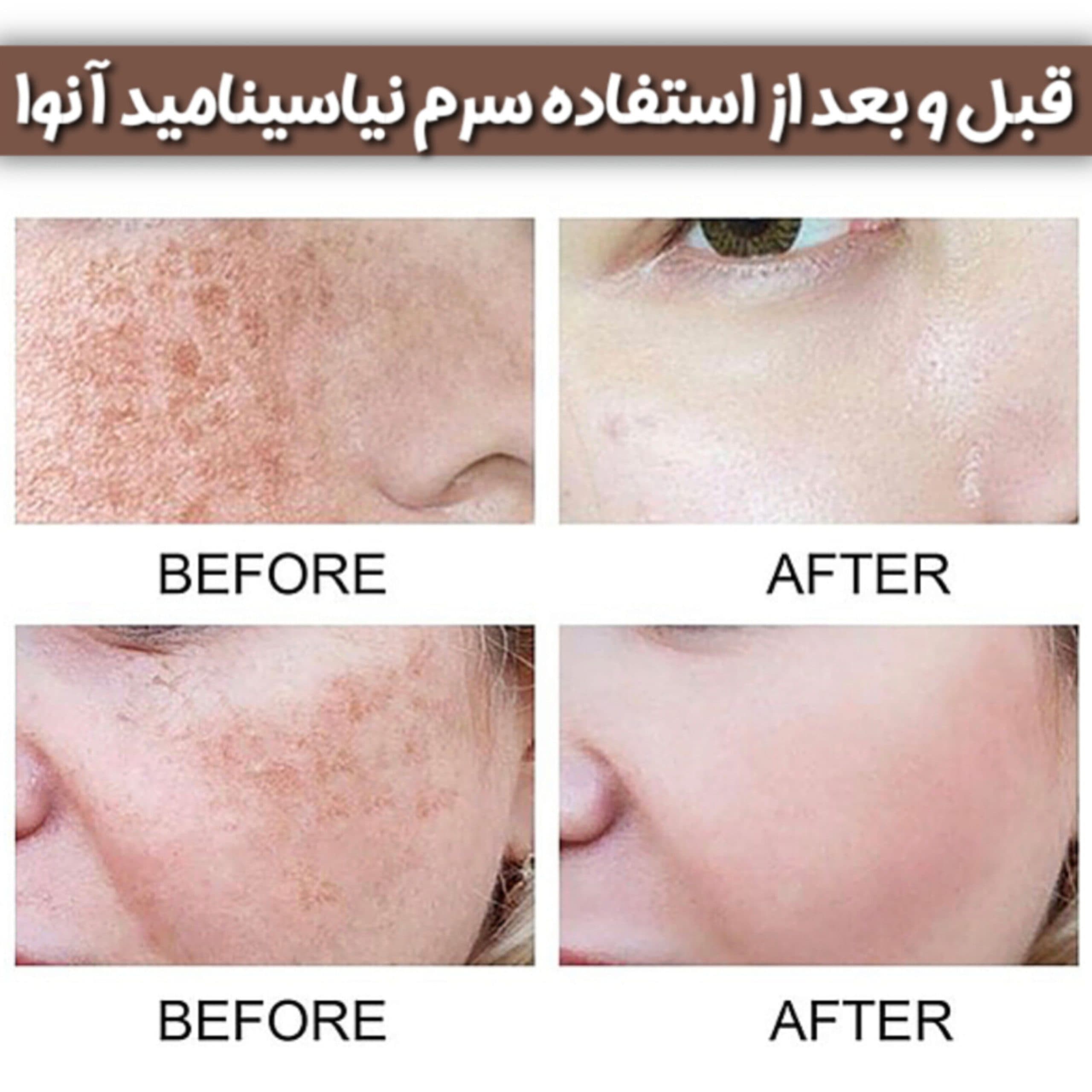 سرم نیاسینامید آنوا | ضد لک و روشن کننده اصل کره — تصویر ۶