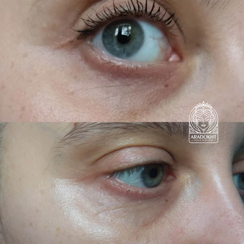 سرم دور چشم ضد چروک و جوانساز مزوفیل مدی پیل MEDI-PEEL Mezzo Filla Eye Serum — تصویر ۹