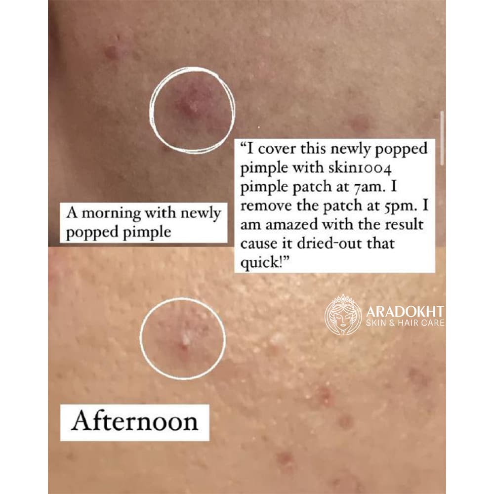 پچ ضد جوش تی تریکا اسکین 1004 SKIN1004 Madagascar Centella Tea-Trica Spot Cover Patch — تصویر ۶