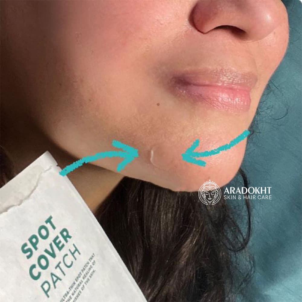 پچ ضد جوش تی تریکا اسکین 1004 SKIN1004 Madagascar Centella Tea-Trica Spot Cover Patch — تصویر ۸