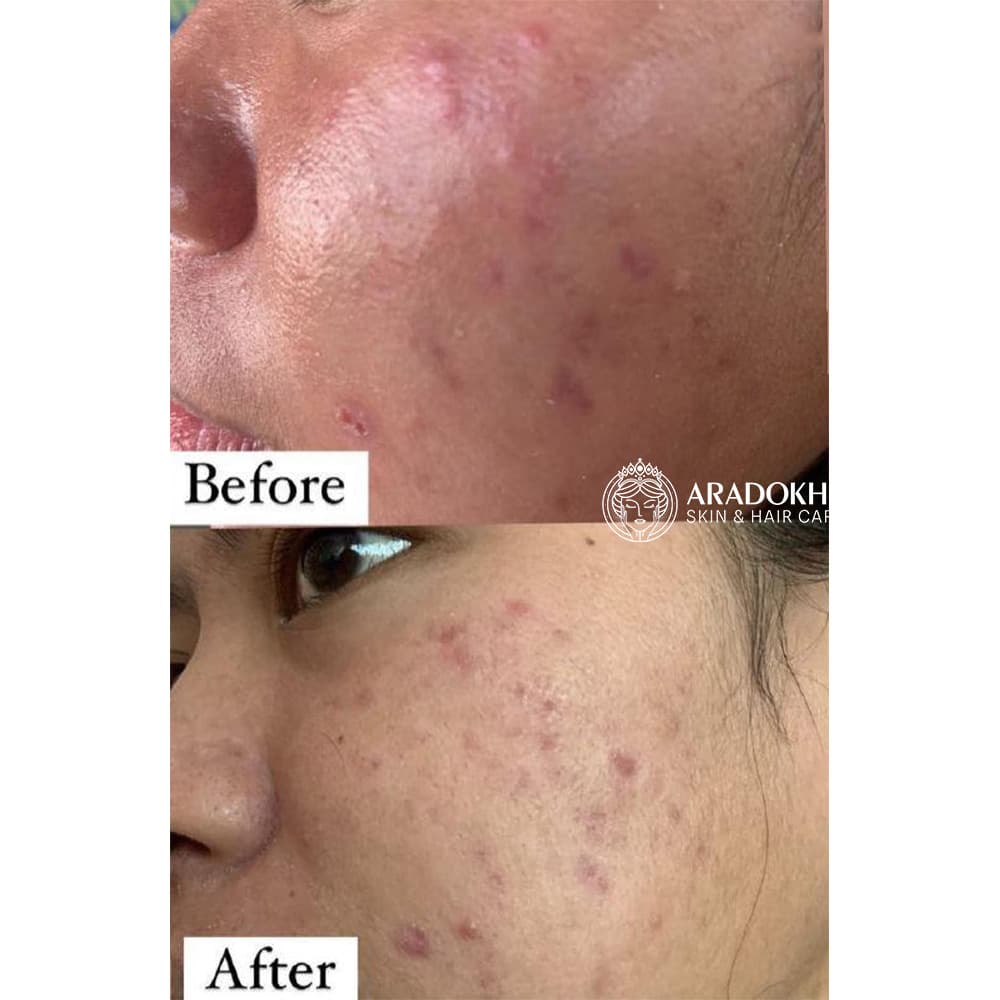 پچ ضد جوش تی تریکا اسکین 1004 SKIN1004 Madagascar Centella Tea-Trica Spot Cover Patch — تصویر ۷
