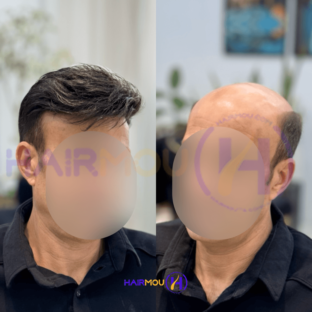 پروتز مو آنکارایی | درجه 1 – ساخت کره