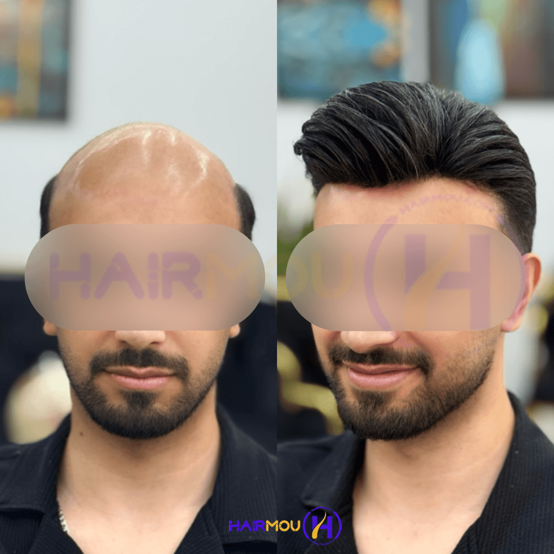پروتز مو هشت تکه | درجه 1 – ساخت کره
