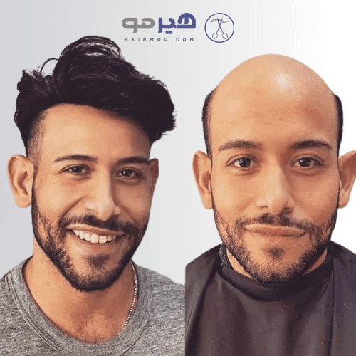 پروتز مو نیوزلندی | مردانه VIP – ساخت چین