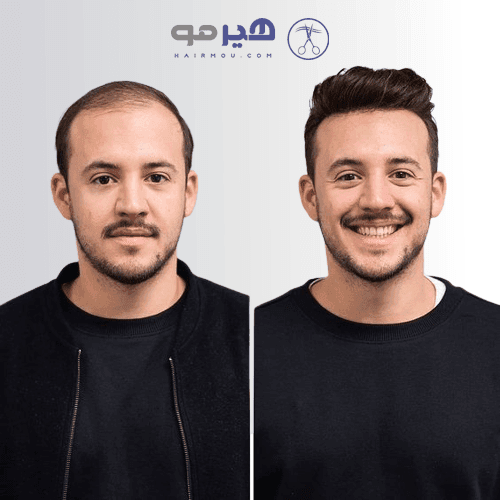 پروتز مو آنکارایی | مردانه VIP – ساخت چین