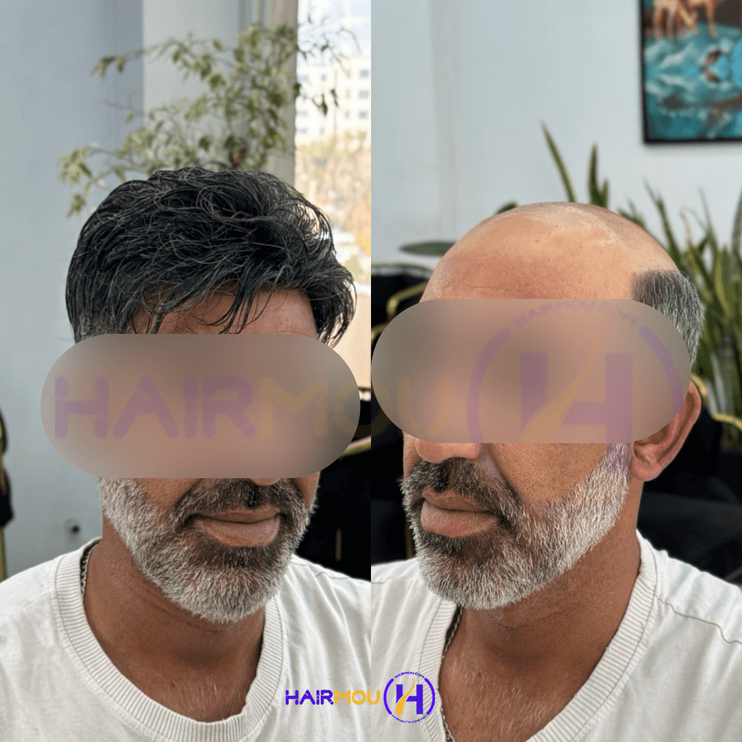 پروتز مو جوگندمی | مردانه درجه 3