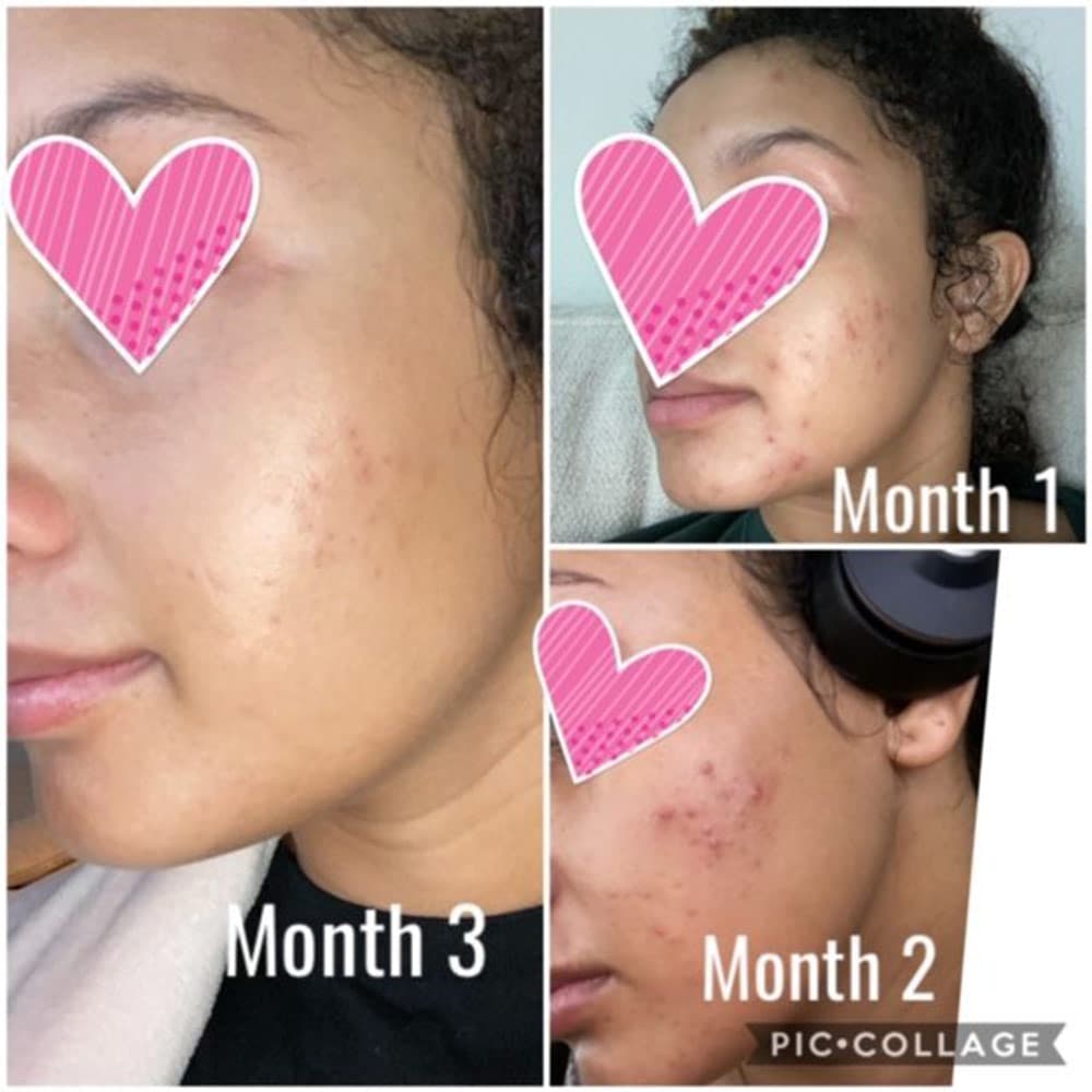 ژل ضد جوش و التهاب دیفرین DIFFERIN حجم 30 میل — تصویر ۱۱