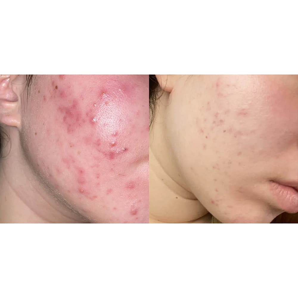ژل ضد جوش و التهاب دیفرین DIFFERIN حجم 30 میل — تصویر ۸