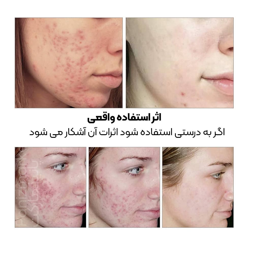 سرم ضد جوش چای سبز بریلی — تصویر ۸