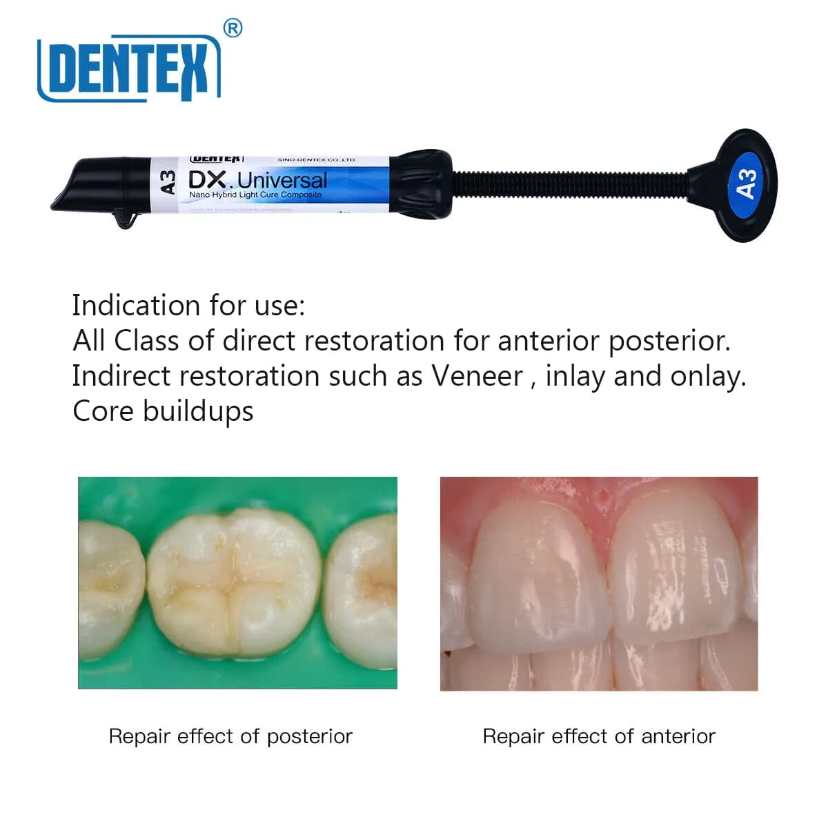 کامپوزیت یونیورسال دنتکس Universal DENTEX — تصویر ۶