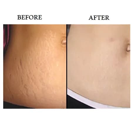 کرم ترمیم کننده ترک پوست استرچ سینوز SINOZ stretch marks cream — تصویر ۹