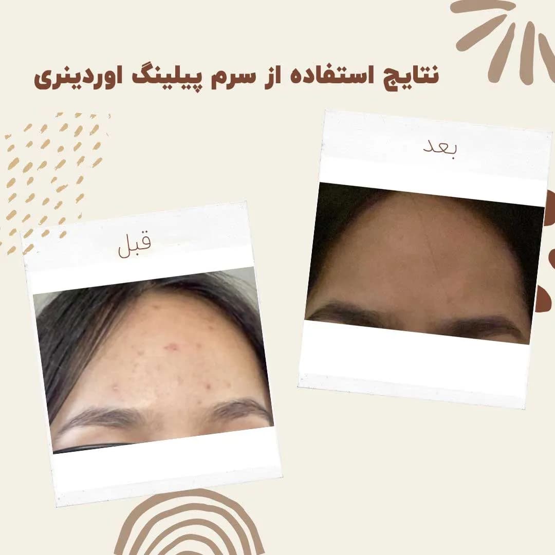 سرم پیلینگ اوردینری قرمز لایه بردار — تصویر ۸