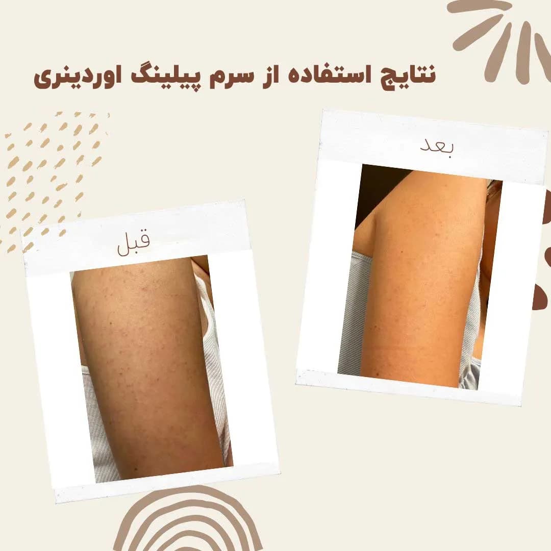 سرم پیلینگ اوردینری قرمز لایه بردار — تصویر ۶