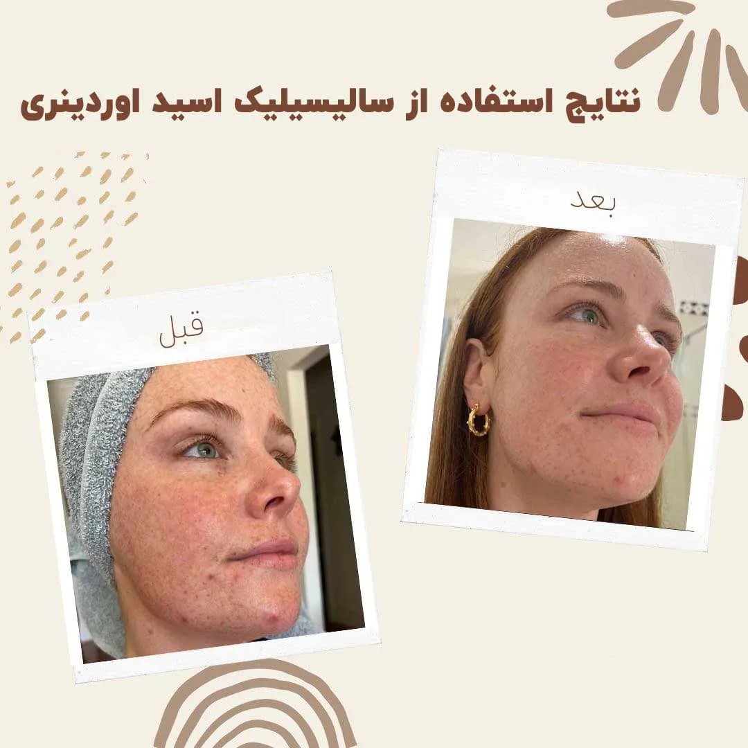 سرم سالسیلیک اسید اوردینری — تصویر ۴