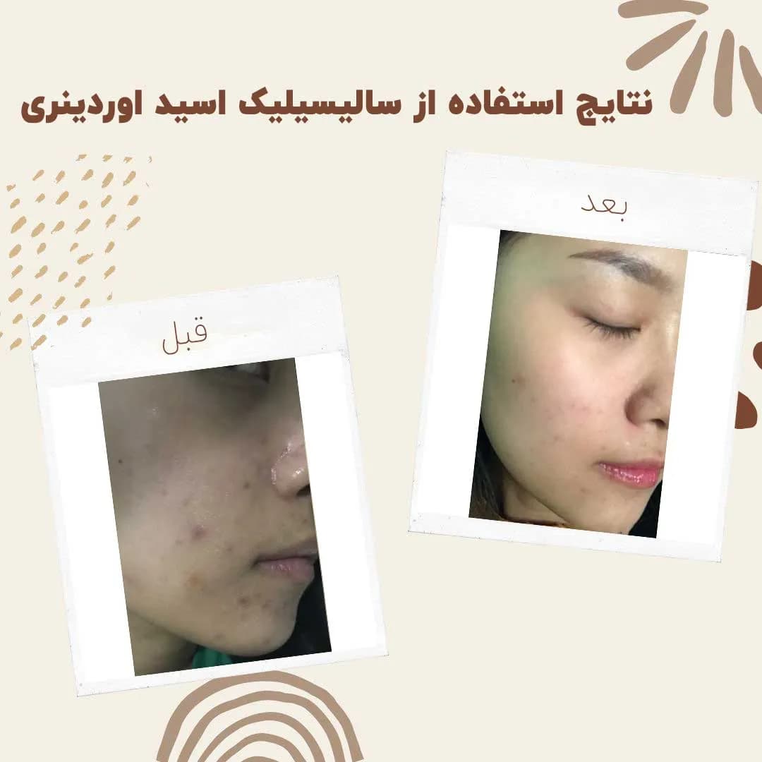 سرم سالسیلیک اسید اوردینری — تصویر ۸
