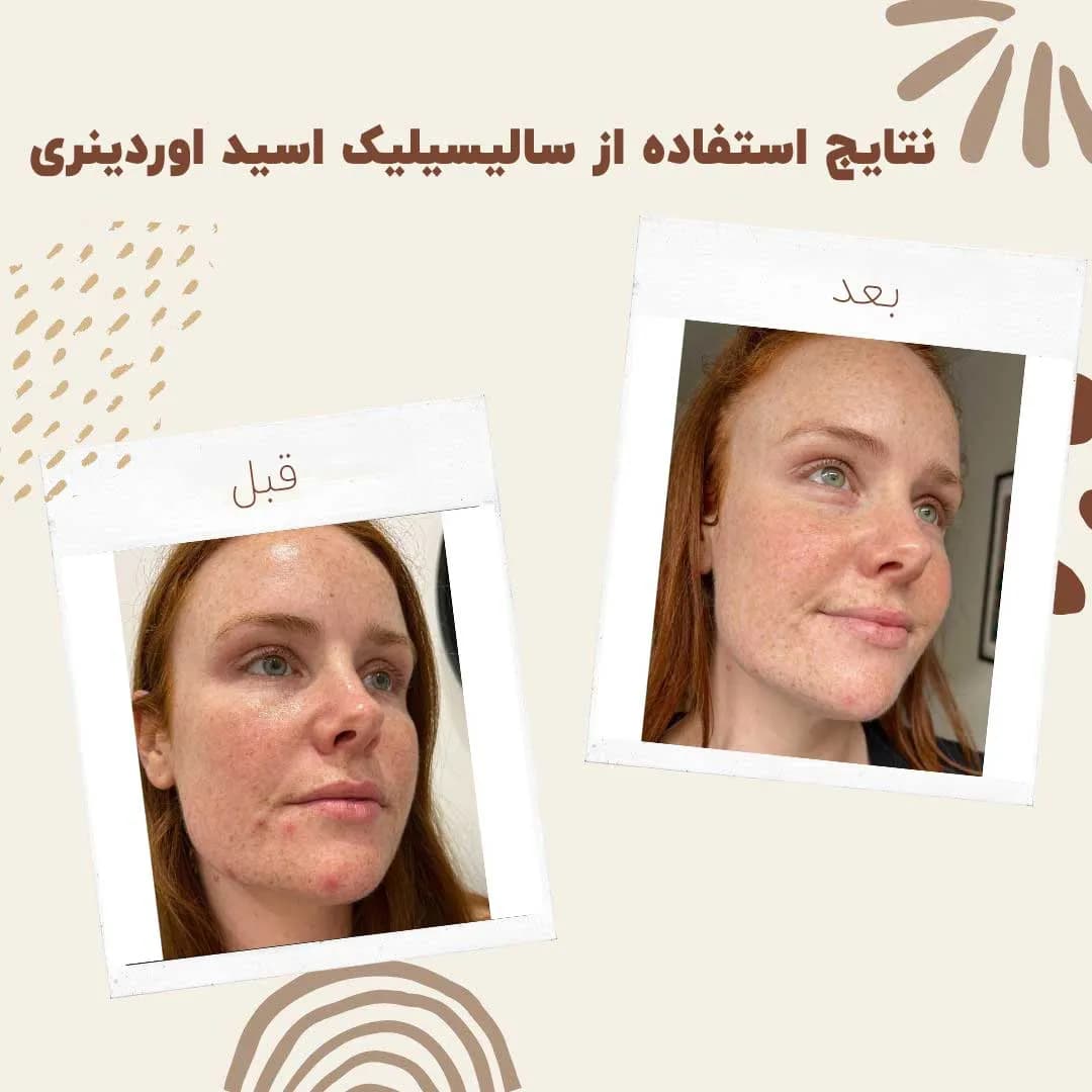 سرم سالسیلیک اسید اوردینری — تصویر ۹