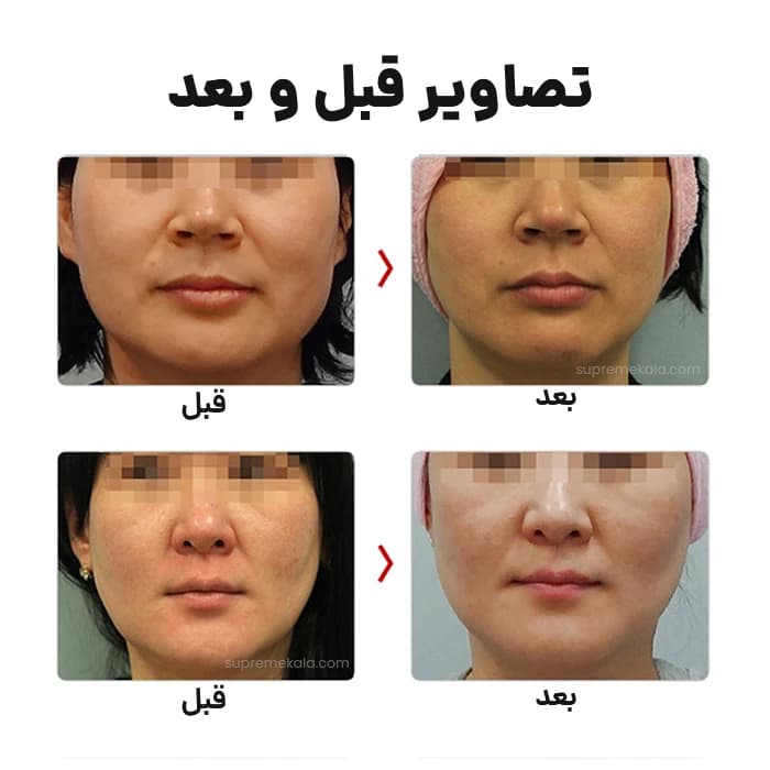 دستگاه هایفو دابلو گلد – Hifu Gold Premium — تصویر ۸