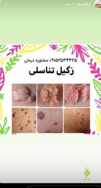 برداشتن زگیل تناسلی با محلول در یک جلسه