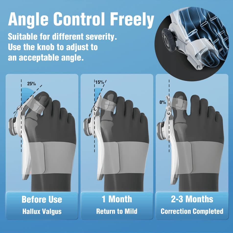 آتل اصلاح کننده بونیون شیائومی مدل Xiaomi Tech Love Bunion Corrector TJ608 — تصویر ۸