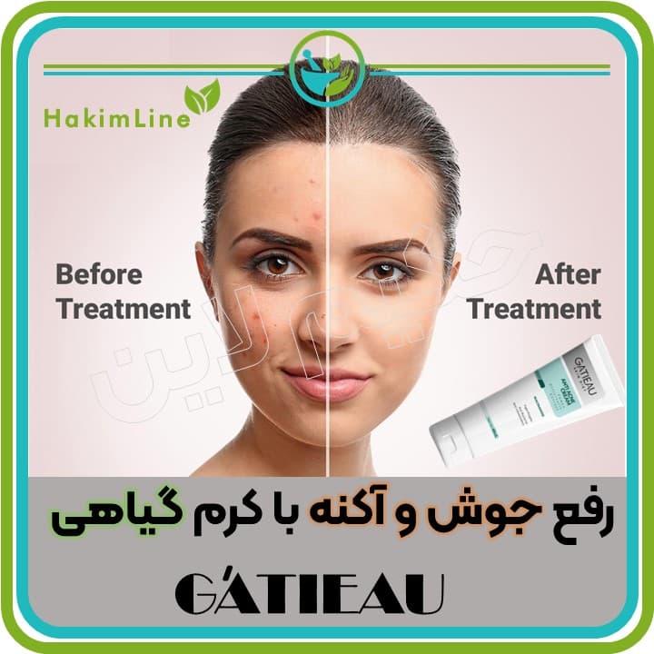 کرم گیاهی GATIEAU – درمان تخصصی جوش و آکنه تحت لیسانس فرانسه (نمایندگی رسمی فروش) — تصویر ۹