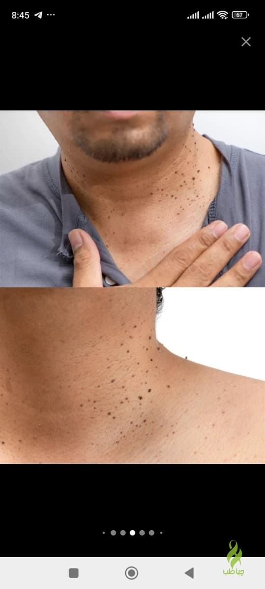محلول برداشتن خال و زگیل و میخچه (در یک جلسه)