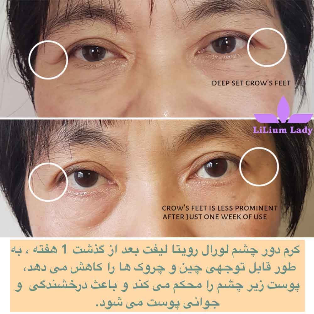 کرم دور چشم رویتالیفت لورال — تصویر ۴