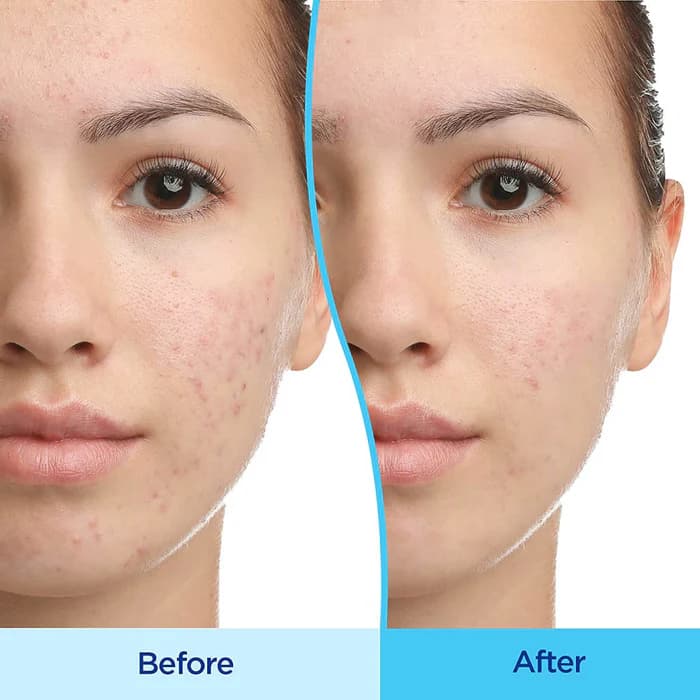 ژل ضدجوش دیفرین اصل — تصویر ۶