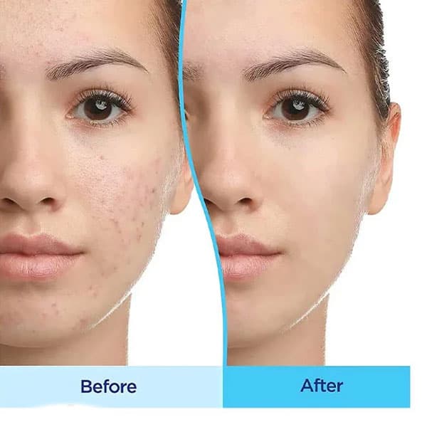 ژل اصلی ضد جوش و لایه بردار دیفرین 30 گرم — تصویر ۶