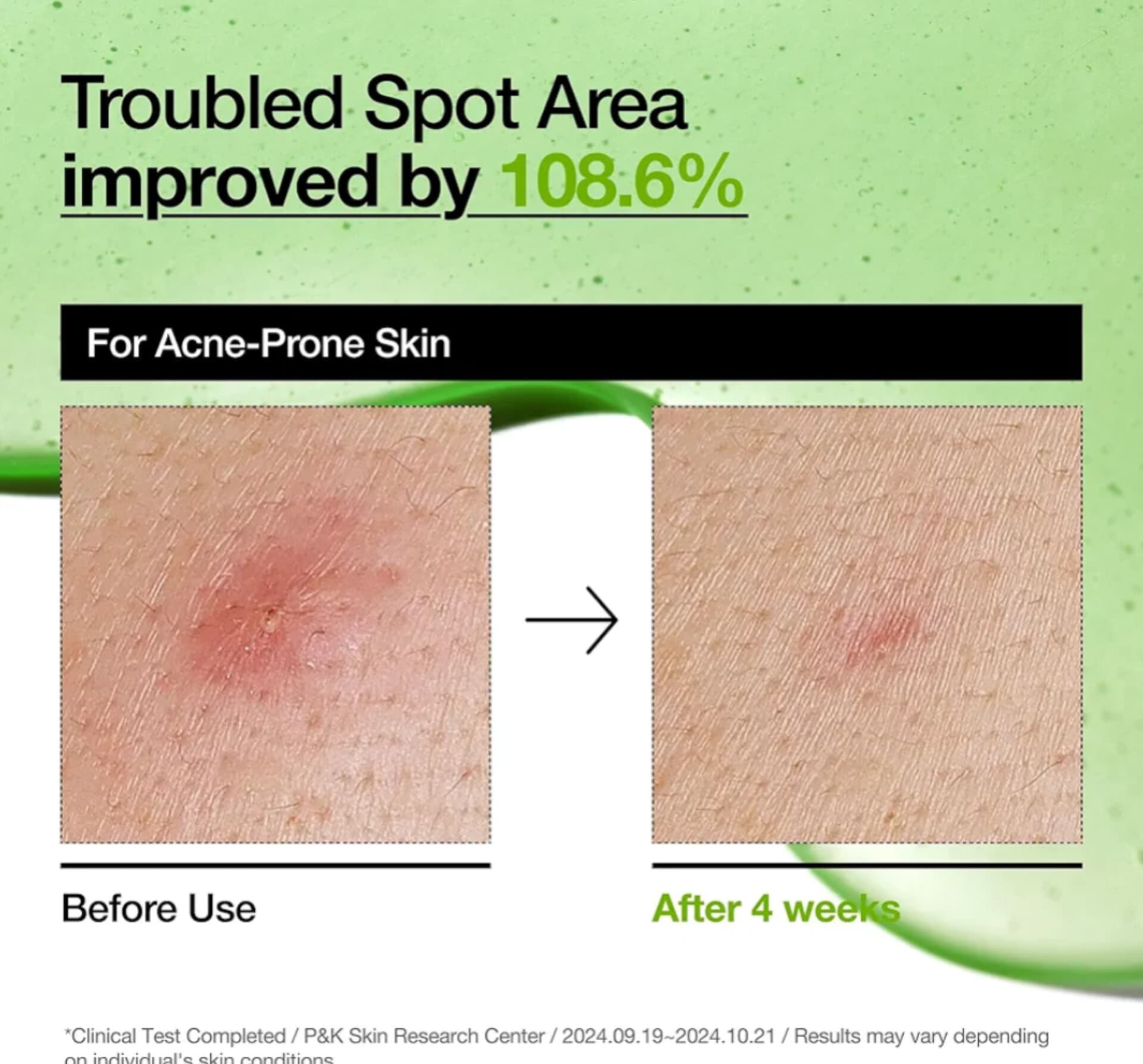 سرم آزلائیک اسید ۱۰ ٪ هیالورون آنوا اصل | Anua Azelaic Acid 10% + Hyaluron Redness Soothing Serum 30ml — تصویر ۵