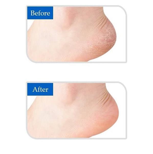 محافظ سیلیکونی پاشنه پا فوت کر مدل FOOTCARE HEEL FOOT SILICONE PROTECTOR A-034 — تصویر ۱۰