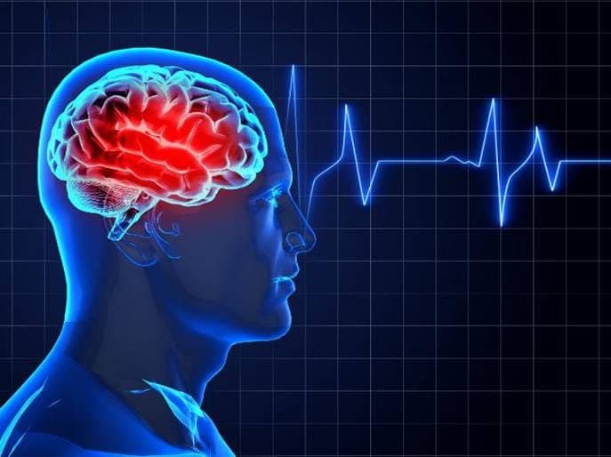 دانلود پوستر مدیریت سکته مغزی حاد(کد 724) گایدلاین 2026 (Stroke Poster)