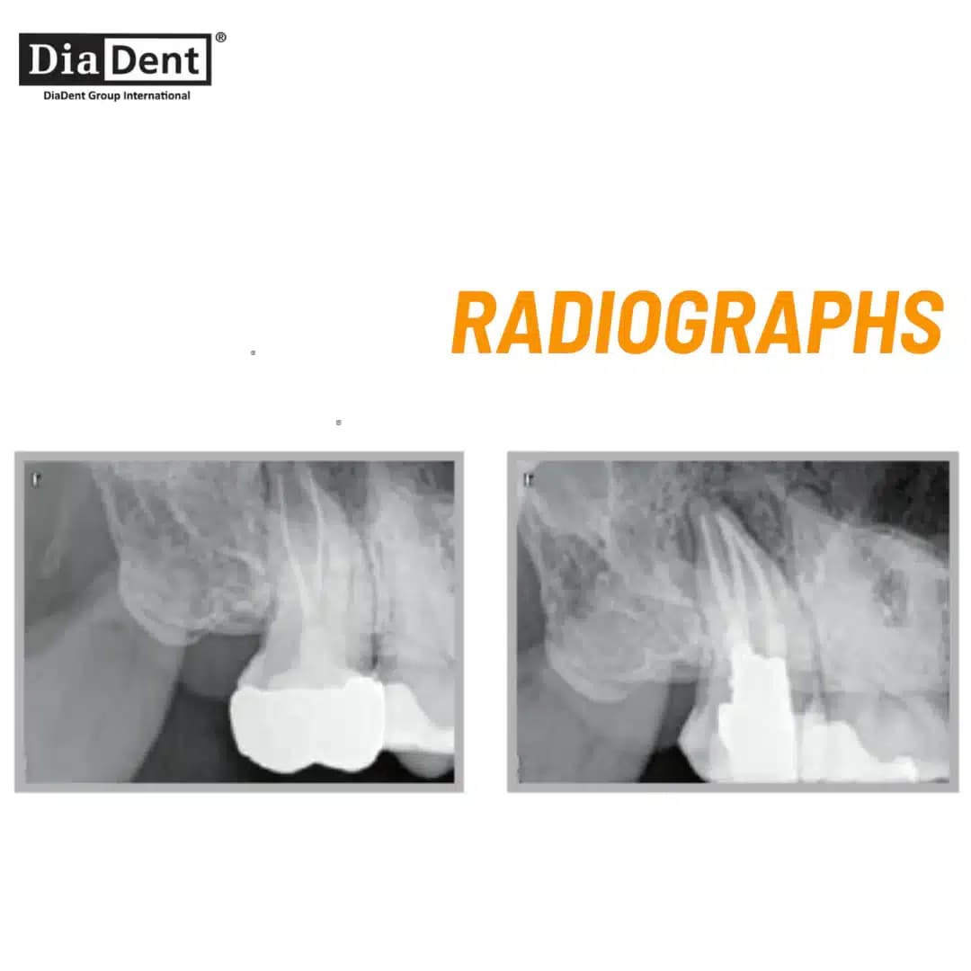 سیلر بیس رزینی دیادنت – Diadent Dia-Proseal — تصویر ۱۱
