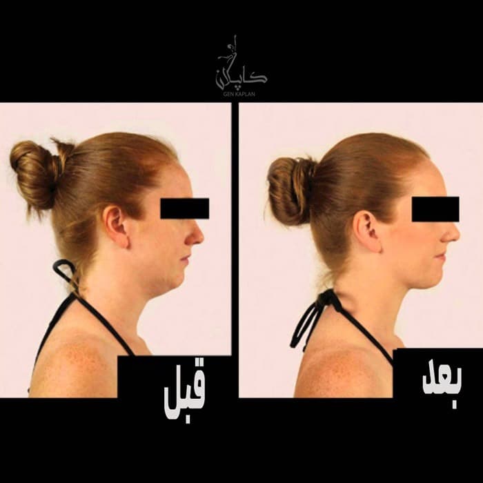 دستگاه رفع غبغب اورجینال Neckline Slimmer — تصویر ۹