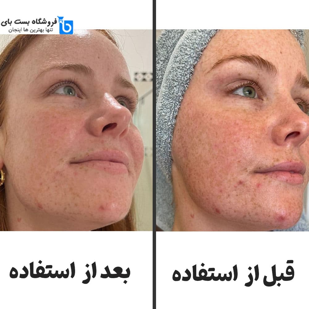 سرم سالیسیلیک اسید اوردینری [ضدجوش] 2% اورجینال — تصویر ۱۱