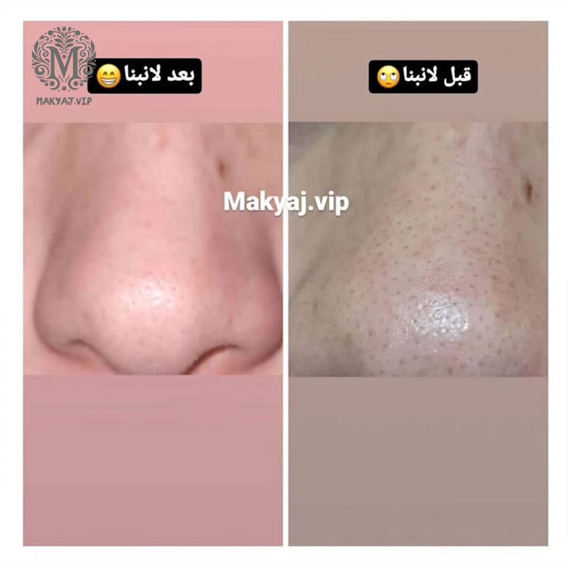 چسب بینی لانبنا کاسه ای سری جدید — تصویر ۳