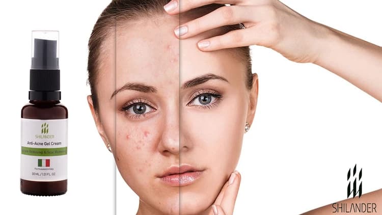 ژل کرم ضد جوش آنتی اکنه 30 میل شیلاندر
