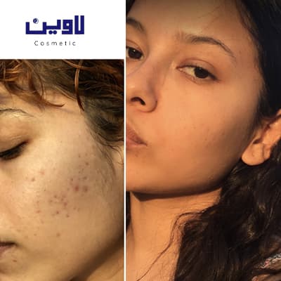 فوم شستشو صورت پوست نرمال تا چرب سراوی 473 میل — تصویر ۸