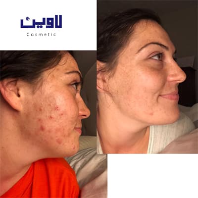 فوم شستشو صورت پوست نرمال تا چرب سراوی 473 میل — تصویر ۳
