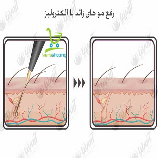 دستگاه الکترولیز ساده star max beauty electrolizer — تصویر ۴
