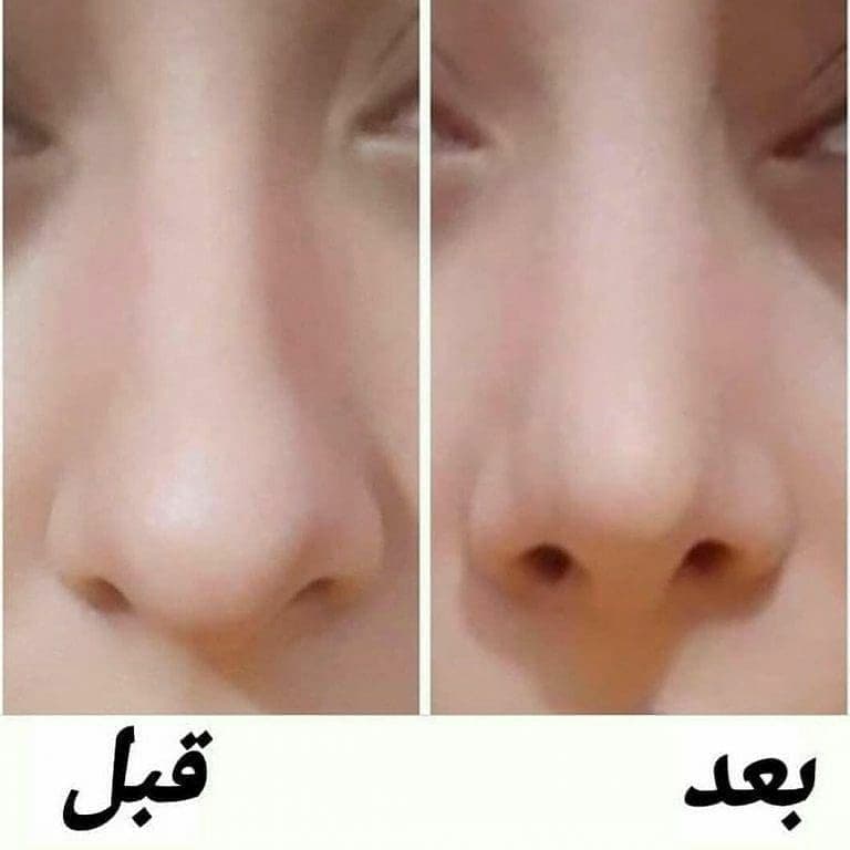 چسب لیفت بینی بی رنگ (نامرئی) — تصویر ۵