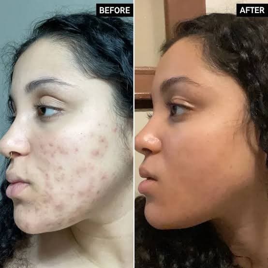 سرم ضدلک و روشن‌کننده نامبوزین شماره 5 Numbuzin No.5 Goodbye Blemish Serum — تصویر ۴
