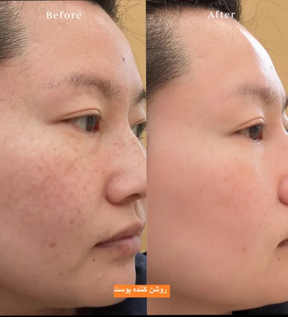 سرم ضدلک و روشن‌کننده نامبوزین شماره 5 Numbuzin No.5 Goodbye Blemish Serum — تصویر ۳