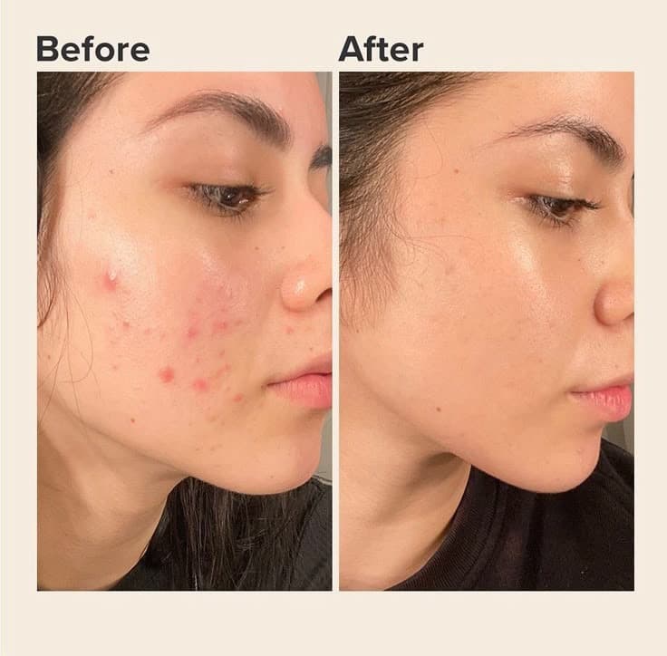 ژل ضدجوش دیفرین Differin Adapalene Gel 0.1% — تصویر ۷