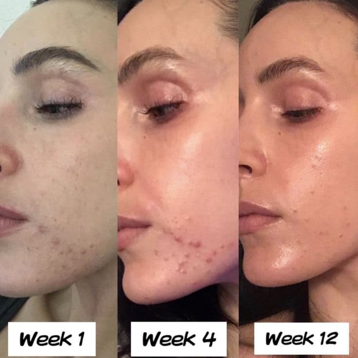 ژل ضدجوش دیفرین Differin Adapalene Gel 0.1% — تصویر ۶