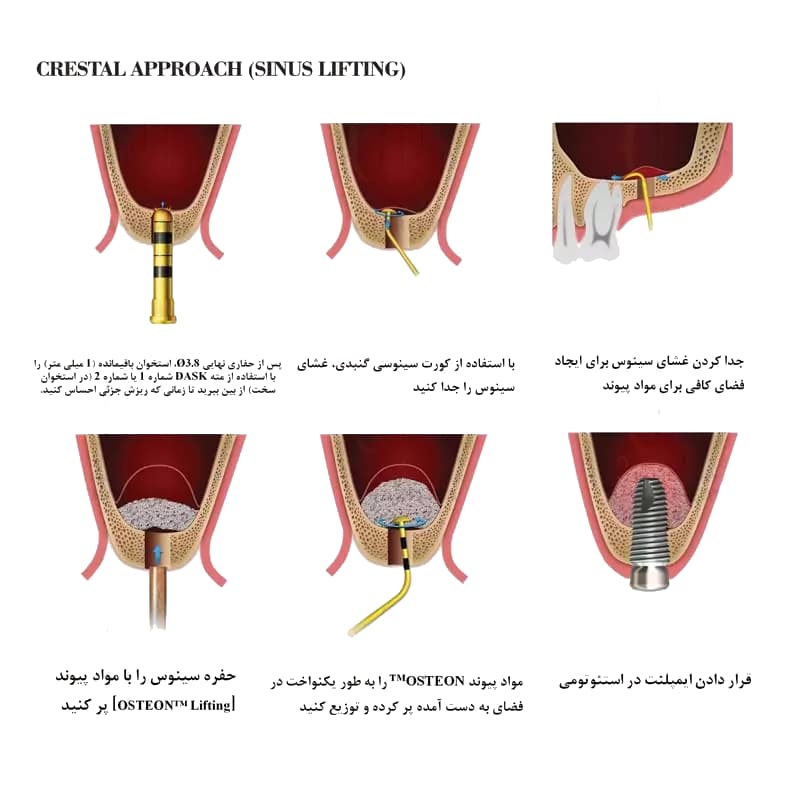 کیت پیشرفته سینوس لیفت اوپن و کلوز کاریزما – 15 عددی – Open & Close Sinus Lift — تصویر ۱۰